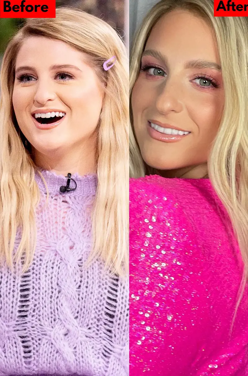 Meghan Trainor before veneers teeth has some gap, while the after picture shows her brighter smile with her new teeth