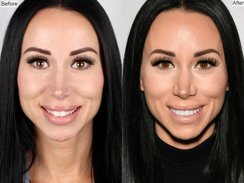 Fuda got 20 porcelain veneers for her smile makeover with the help of Mackenzi Dooley DDS from Smile Texas in Huston.